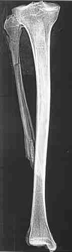 Röntgenbild des rechten Unterschenkels