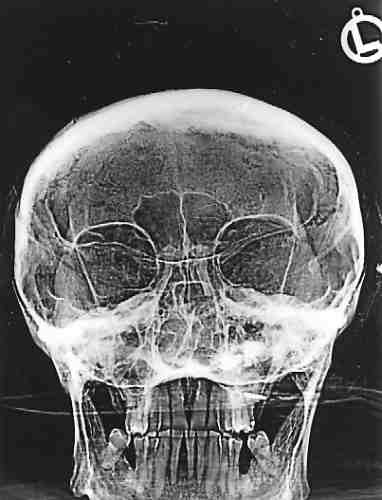 Röntgenansicht Schädelfront