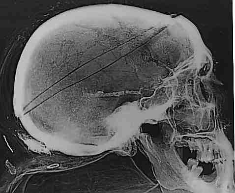 Röntgenansicht Schädelseite